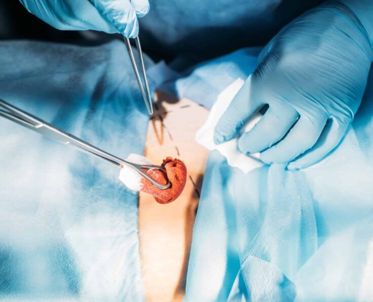cropped image of surgeons operating patient abdomen in operating room